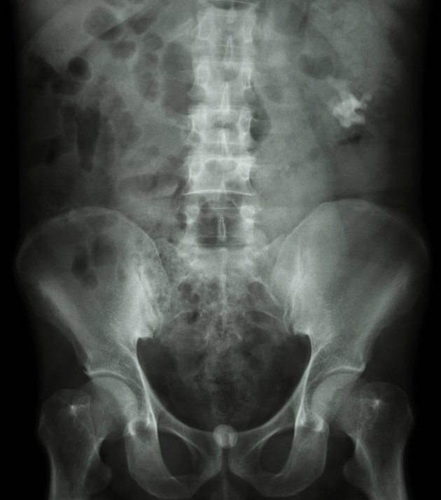 Left kidney & bladder stone