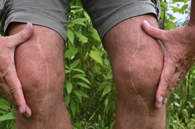 Scars