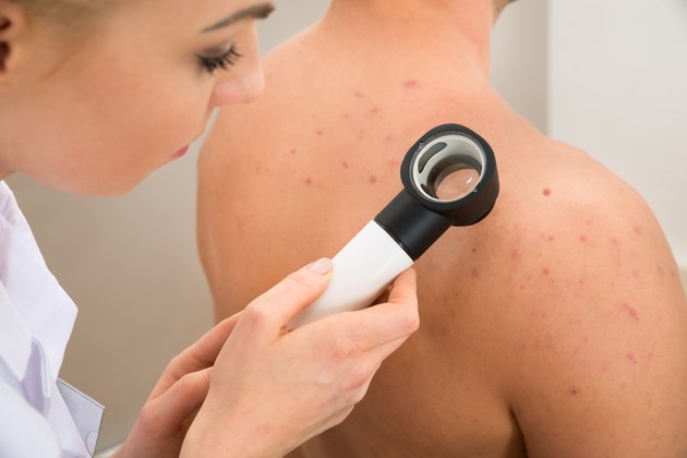 Doctor Examining Pigmented Skin