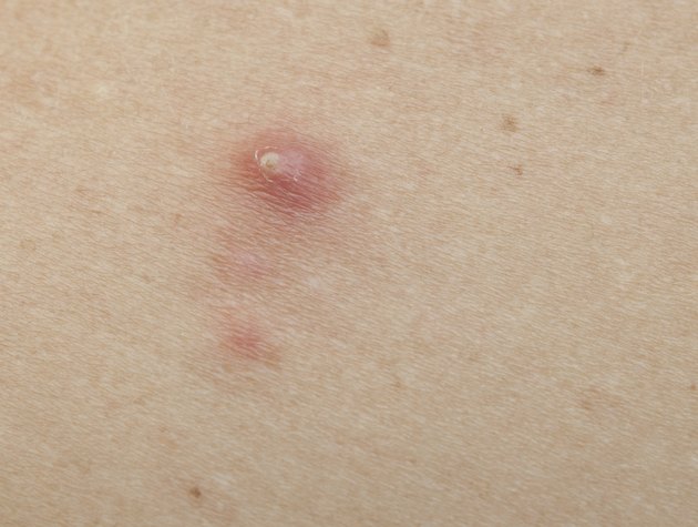pimple extreme on human skin. macro