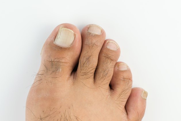 fungi on toenail isolated