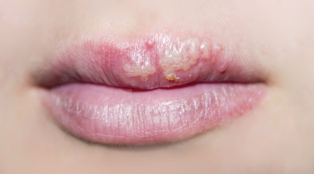 manifestation of herpes
