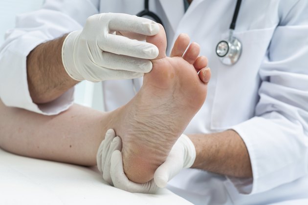 Tinia pedis or Athlete's foot