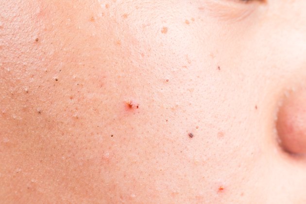 Closed up of acne, pimple and blackheads on face
