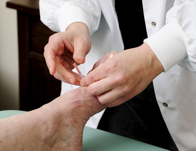 Acupuncture needle Being Applied to a Foot