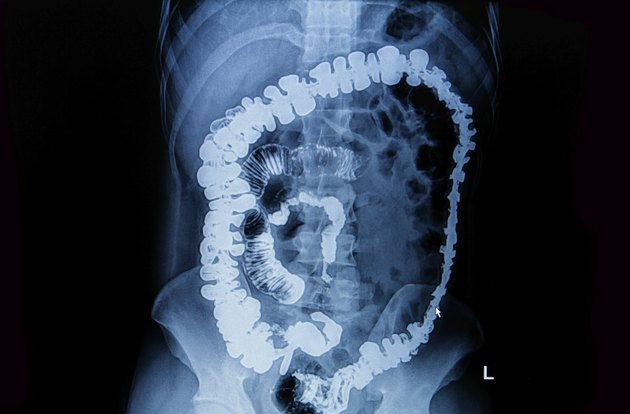 barium enema demonstrated the normal rectum and cecum