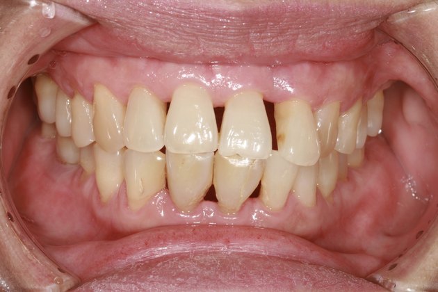 gingival recession.