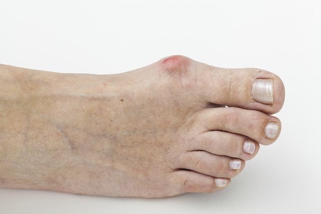 Bunion, isolated background