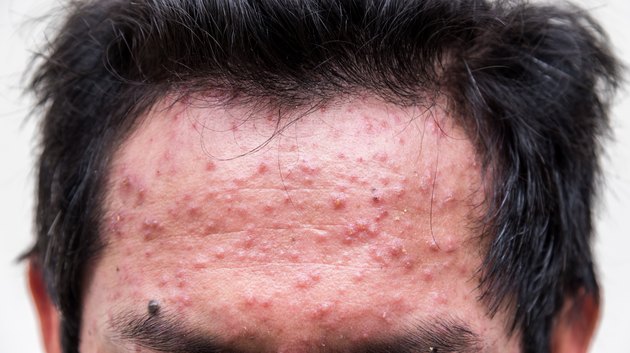 fore head of man having varicella blister or chickenpox