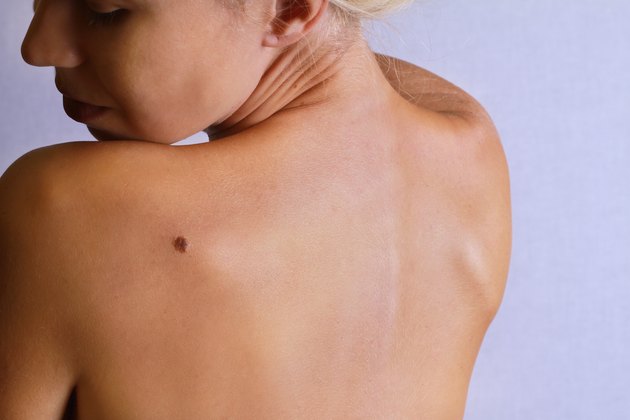 Young woman lookimg at birthmark on back, skin.
