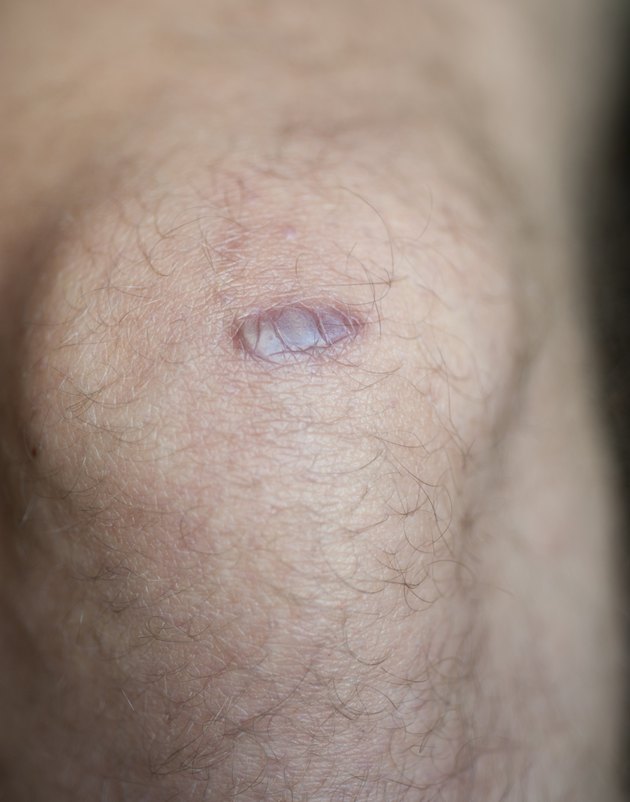 Keloid Scar