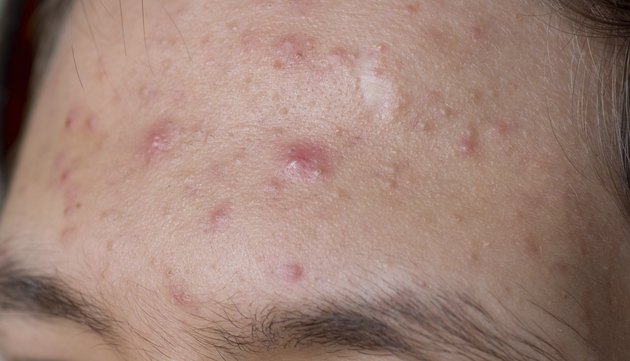 acne
