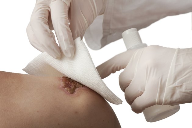 Wound dressing