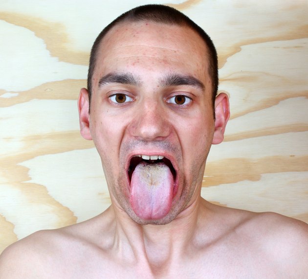 Infection tongue