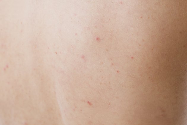 Acne skin close-up