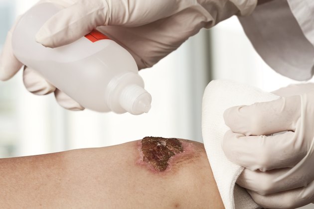 Disinfecting the wound