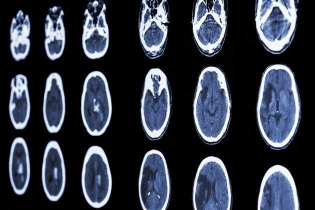 CT scan of brain show ischemic stroke and hemorrhagic strok