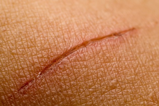 close up scar on skin