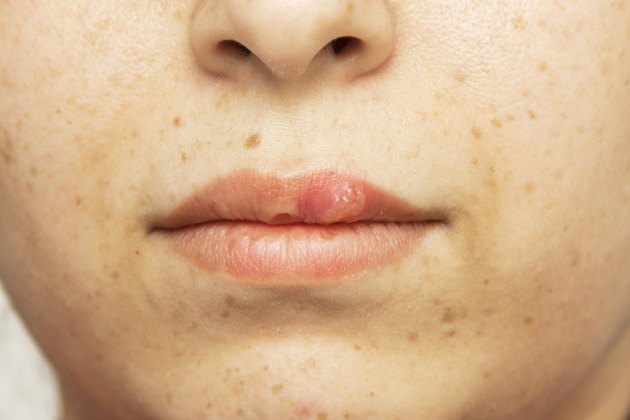 herpes oral cold sore blisters on the lips- herpes simplex