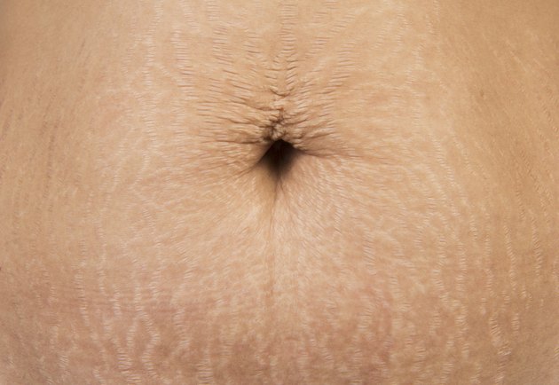 Stretch Marks