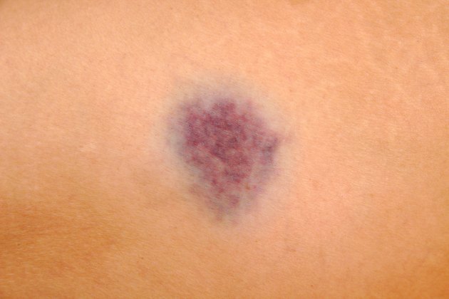 Close up of bruise on wounded woman leg skin. Gender