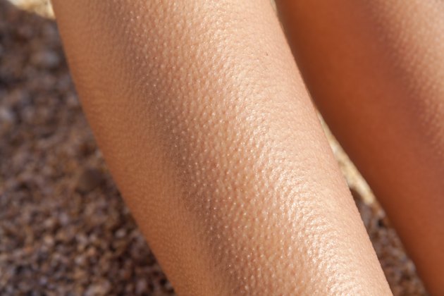 rash-that-looks-like-goosebumps-livestrong