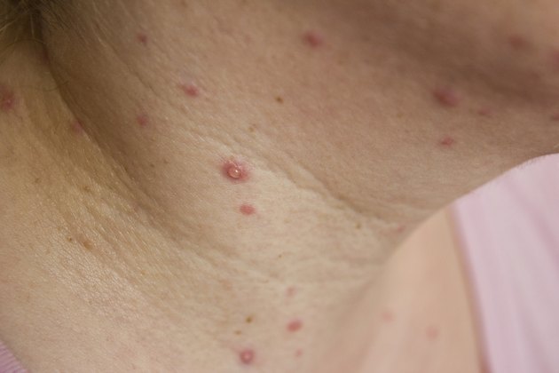 chickenpox