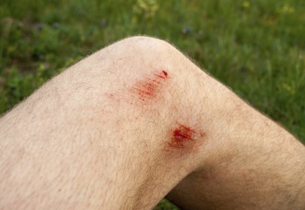 scratches on the knee