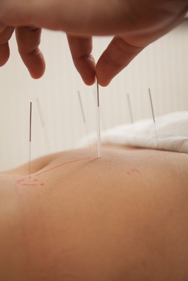 Inserting Acupuncture Needles