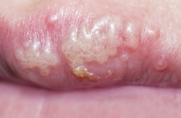 manifestation of herpes