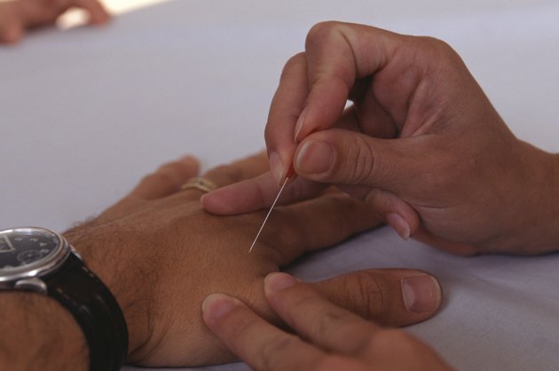 Person having acupuncture on hands, close-up