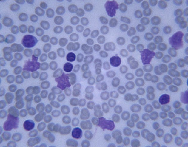 Microscopic Image of Infected Blood