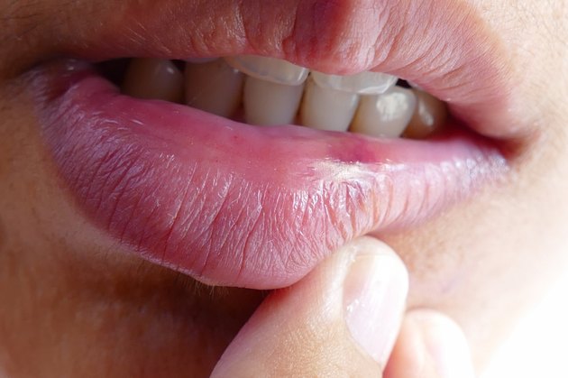 How To Heal A Cold Sore On Lips