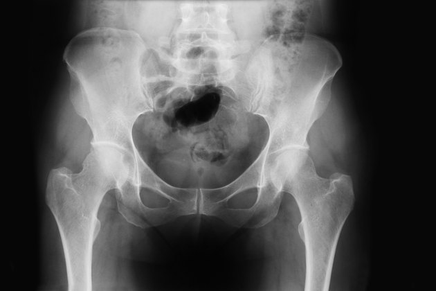 X-ray of human pelvis
