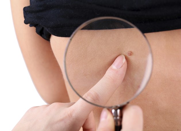 Dermatologist examines birthmark of patient, close up