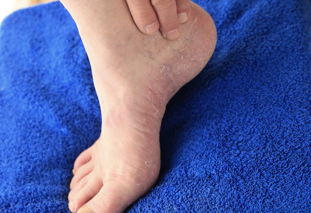 Closeup of dry skin on foot