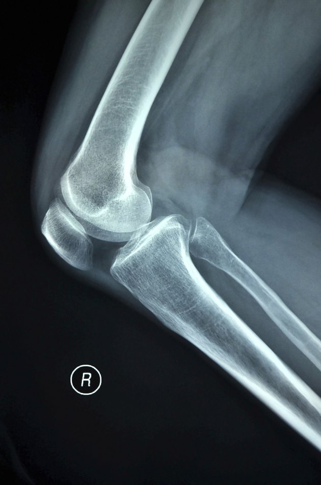 Right knee joint X-ray photograph
