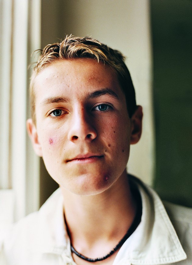 Portrait of a Male Teenager With Acne