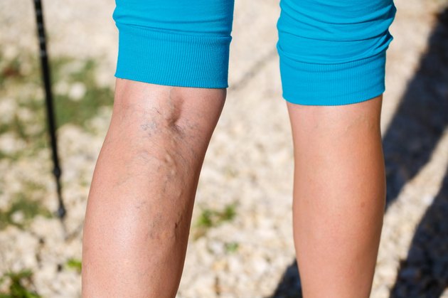 Varicose veins