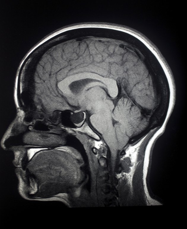 MRI Sagittal Brain