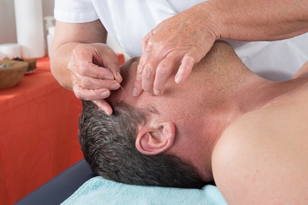 Man in an acupuncture therapy at the health spa