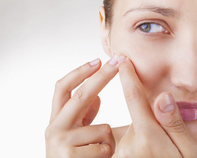 Acne in women