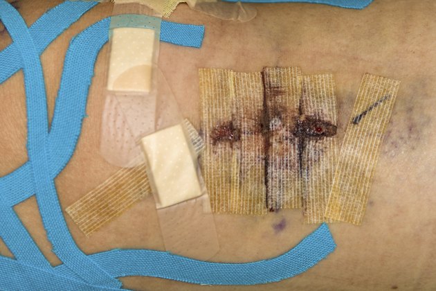 Bandages and dressing after knee surgery