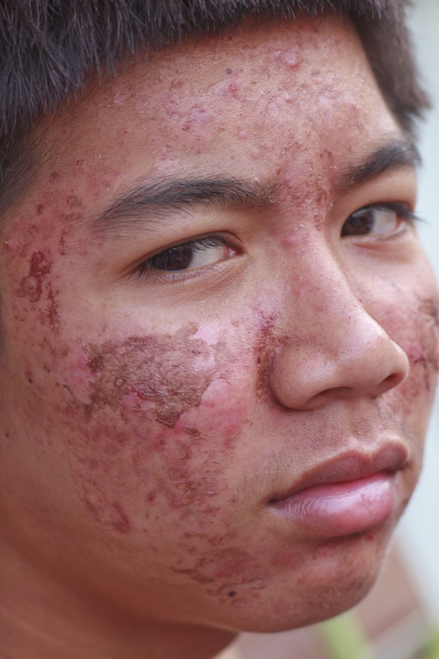 Male ace with acne problem skin