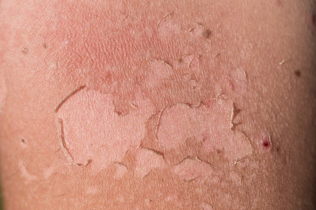 Sunburn