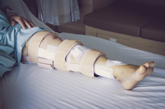 woman wearing a leg brace, Broken leg