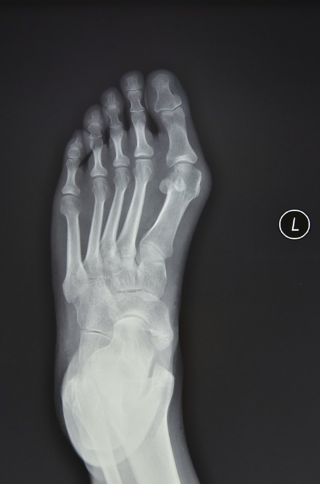 Left foot X-ray