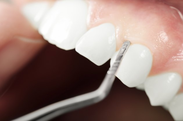 Gums examination. Close up