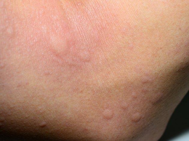 ill allergic rash dermatitis eczema skin texture.