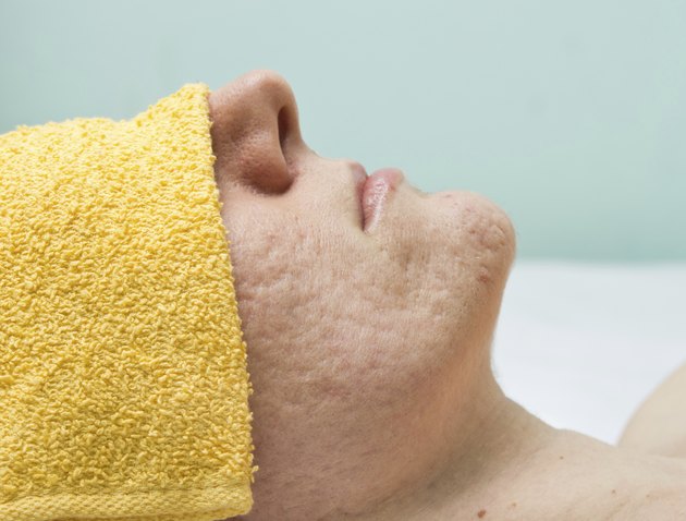 how-to-get-rid-of-cystic-acne-scars-livestrong